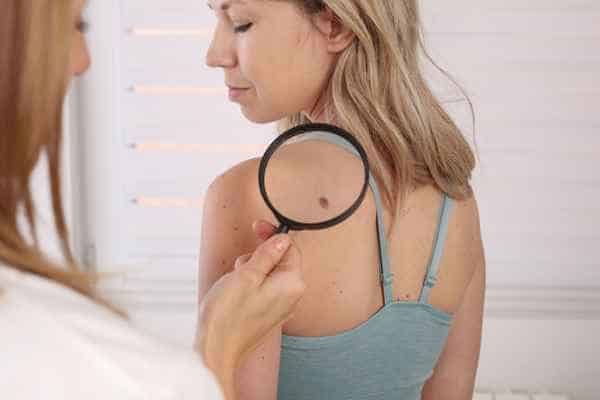 What Are Traditional Skin Lesion Removal Methods Willenhall?