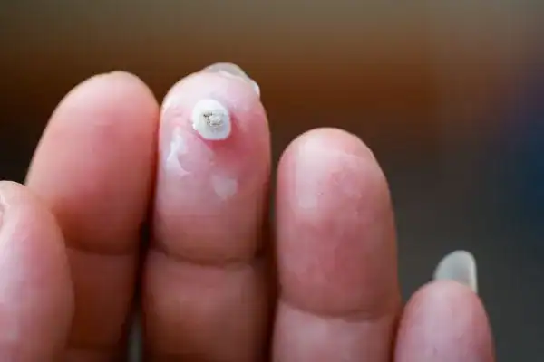 Image of white wart before cryopen treatment Willenhall