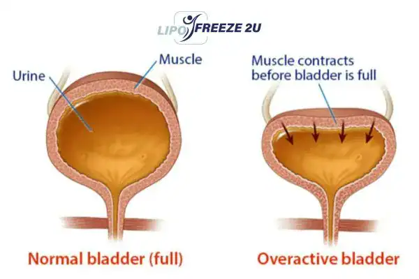 diagram of overactive bladder treatment Willenhall