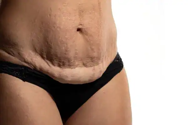 loose skin after weight loss injections Willenhall