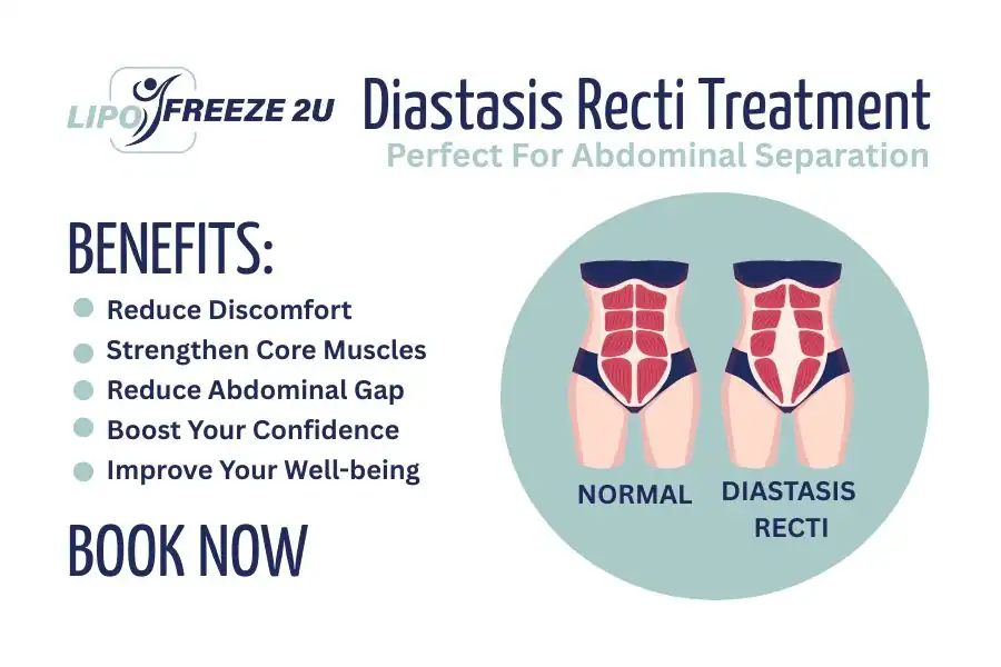 How Long Will It Take to See Improvements in Diastasis Recti Willenhall