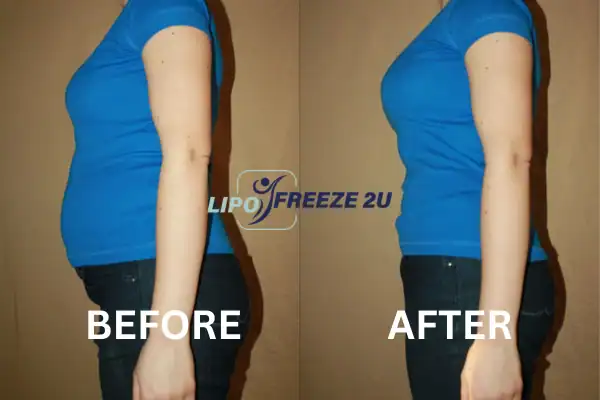 Fat freezing before and after results from Lipo Freeze2U Willenhall