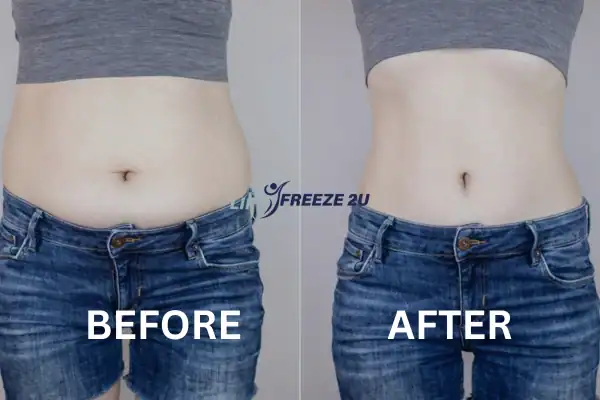 image of womans stomach before and after fat freezing treatment Willenhall Results