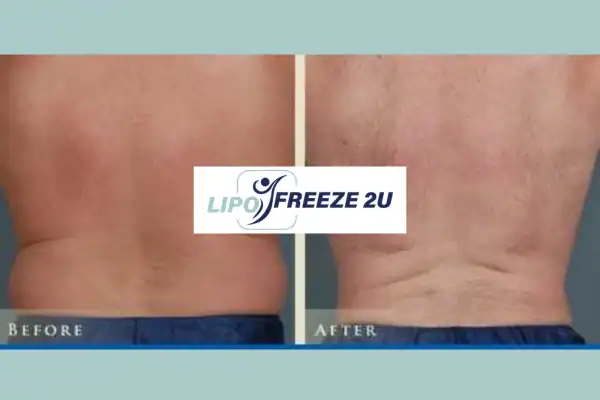 Fat freezing Willenhall before and after results for mans love handles