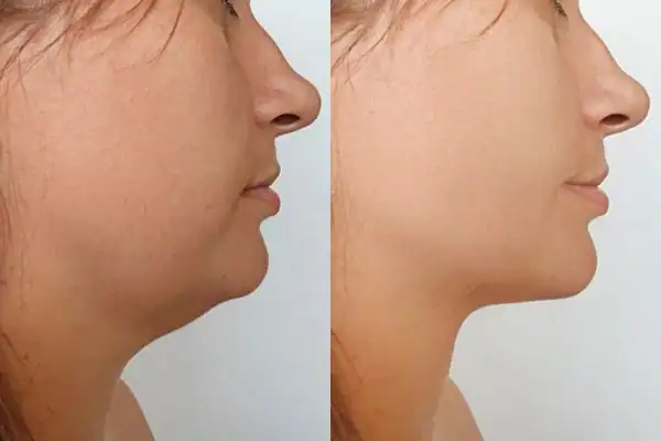 Fat dissolving injections results Willenhall