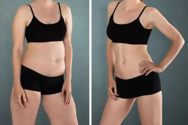 Fat dissolving injections results Willenhall