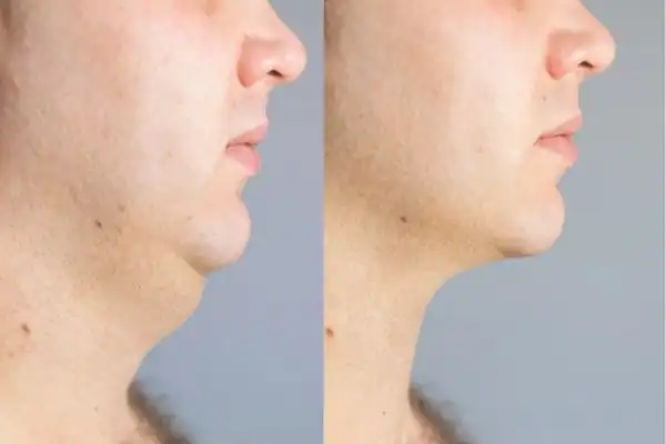 Fat dissolving injections results Willenhall