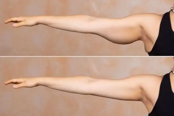 Results on the arms of fat dissolving injections Willenhall