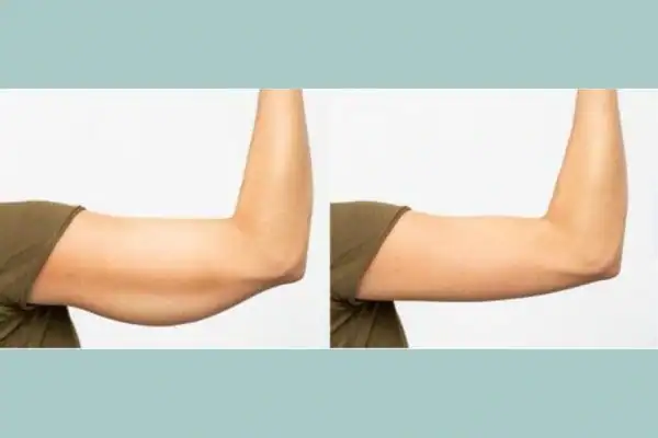 Body toning treatment Willenhall before and after results