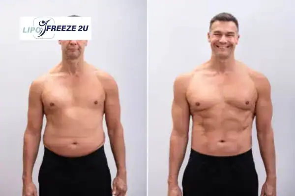 Body toning treatment Willenhall before and after results