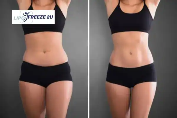 Body toning treatment Willenhall before and after results