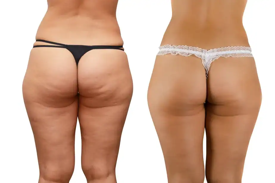 Before and after cellulite treatment Willenhall results.