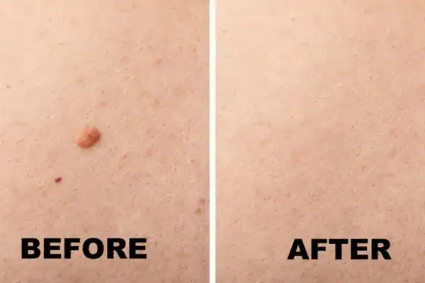 mole removal results before and after Cryopen Cryotherapy Treatment Willenhall