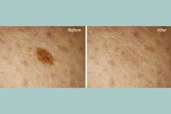 Before and after age spot removal following Cryopen Cryotherapy Treatment Willenhall