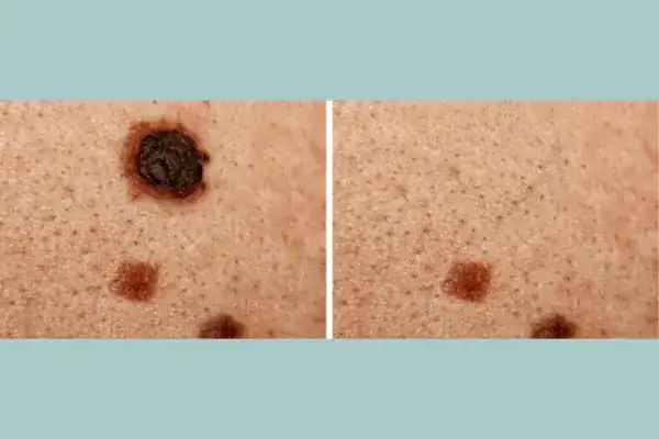 Before and after results from Cryopen Cryotherapy Treatment Willenhall