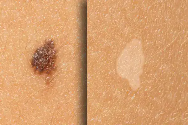 Before and after results Cryopen Cryotherapy Treatment Willenhall