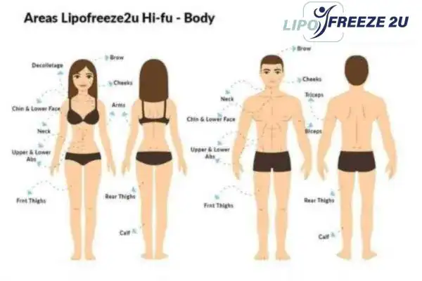 image of areas of the body and HIFU prices Willenhall