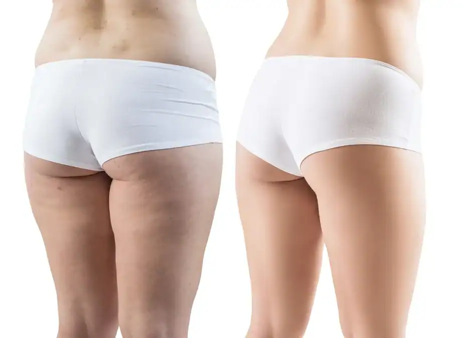 before and after Inner thighs toning treatment Willenhall results