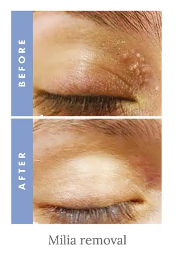 Before and after results of milia removal treatment Willenhall.