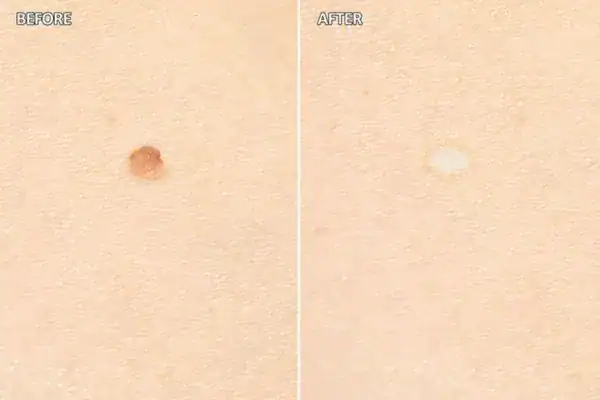 mole removal Willenhall before and after results following cryopen treatment