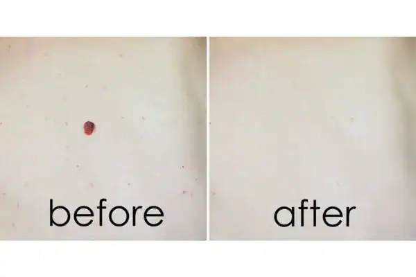 before and after mole removal Willenhall results