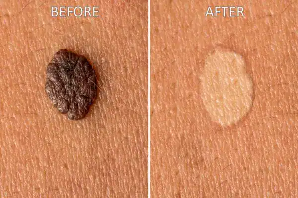 cryopen before and after results for mole removal Willenhall