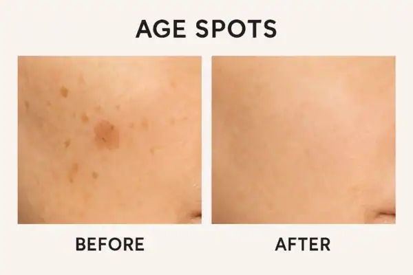Before and after results of age spots removal Willenhall