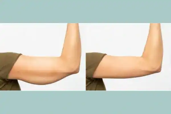 Before and after results of arm toning treatment Willenhall