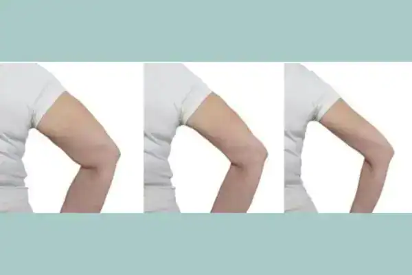 before and after results of arm toning treatment Willenhall