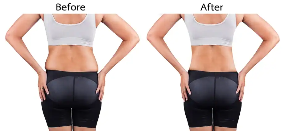 Before & After back toning treatment Willenhall