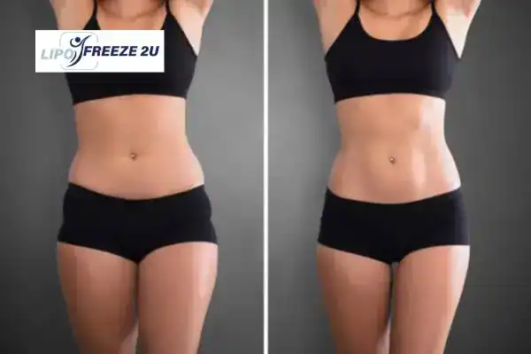How Can LIPO FREEZE 2U Support Your Post-Pregnancy Body Recovery Willenhall?