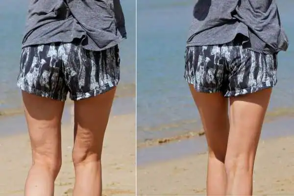 before and after results of cellulite treatment Willenhall