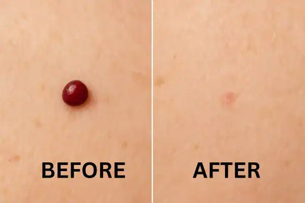 Cherry angioma removal Willenhall before and after results
