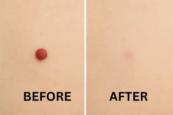Results of before and after Cherry angioma removal Willenhall