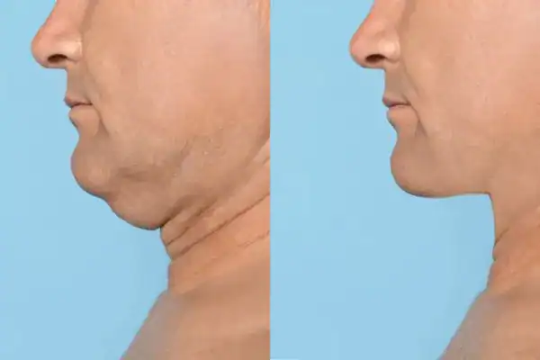 mans before and after chin toning treatment Willenhall results.
