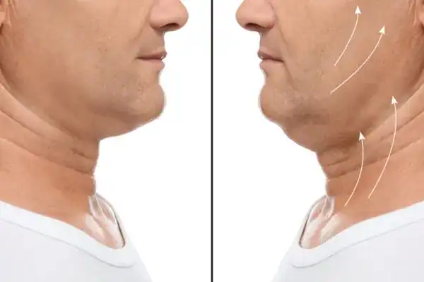 Before and after chin toning treatment Willenhall results.