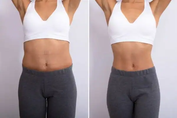 Before and after results of Hip toning treatment Willenhall
