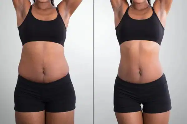 before and after hip toning treatment Willenhall