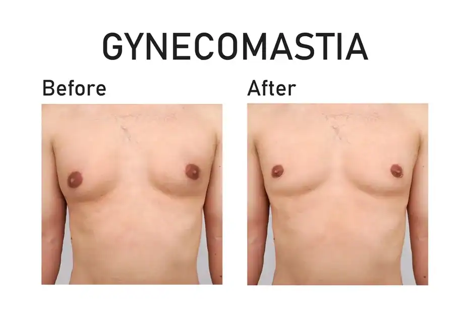 before and after man boobs treatment Willenhall