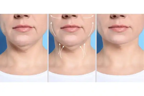 womans result of neck toning treatment Willenhall