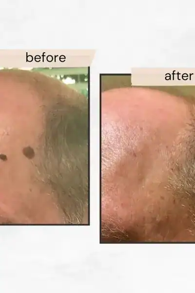 Results of before and after seborrheic keratosis treatment Willenhall