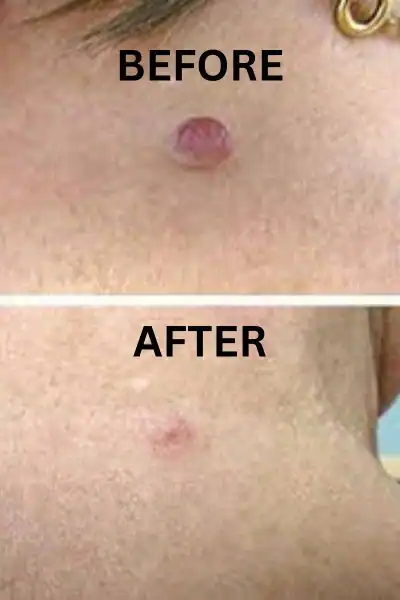 Before and after results of skin tag removal treatment Willenhall