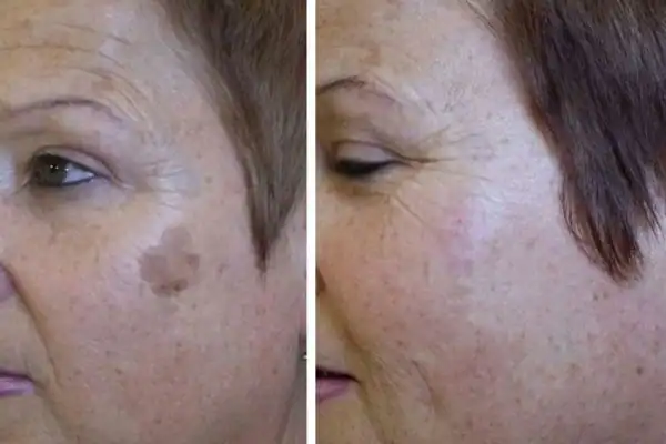 Before and after results of sun damage removal Willenhall