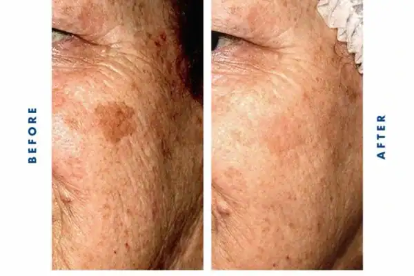 Before and after results of sun damage removal Willenhall