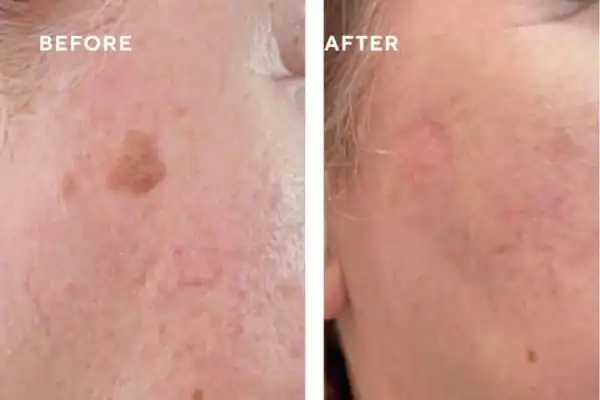 Before and after results of sun damage removal Willenhall