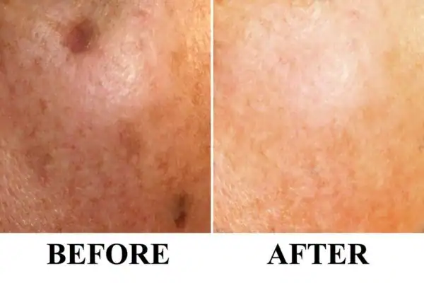 Before and after results of sun damage removal Willenhall