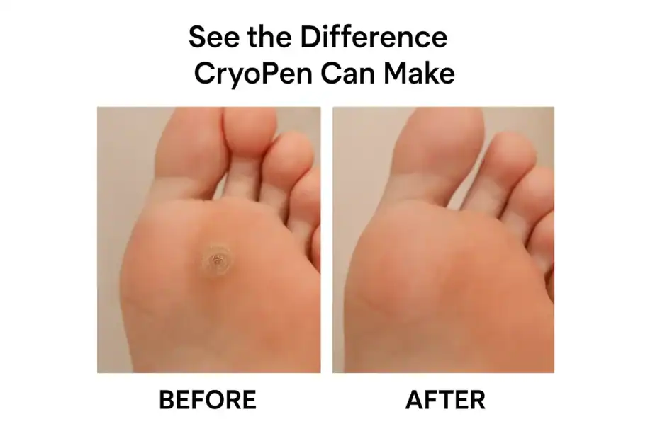 Before and after results of verrucae treatment Willenhall