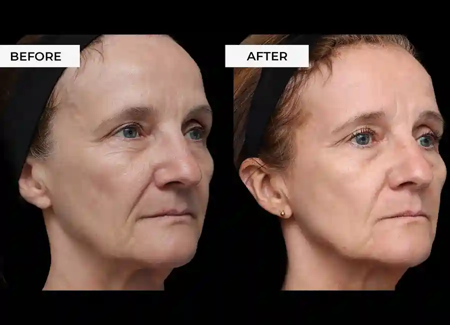 How Many RF Microneedling Sessions Will You Need to See a Difference Willenhall?