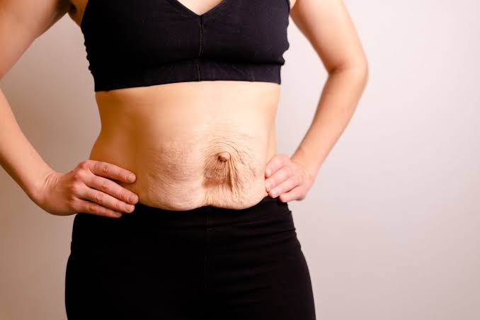 Is Surgery Really the Only Way to Repair Diastasis Recti Willenhall?