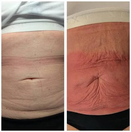 How Does RF Microneedling Improve Crepey, Thin and Uneven Skin Texture Willenhall?